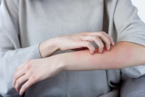 腕のアレルギー
